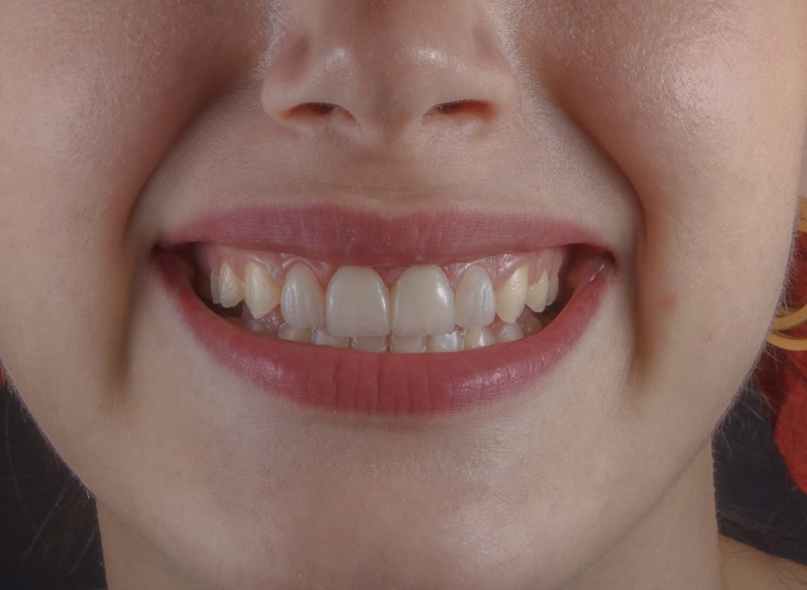 Blanqueamiento dental (Zoom)