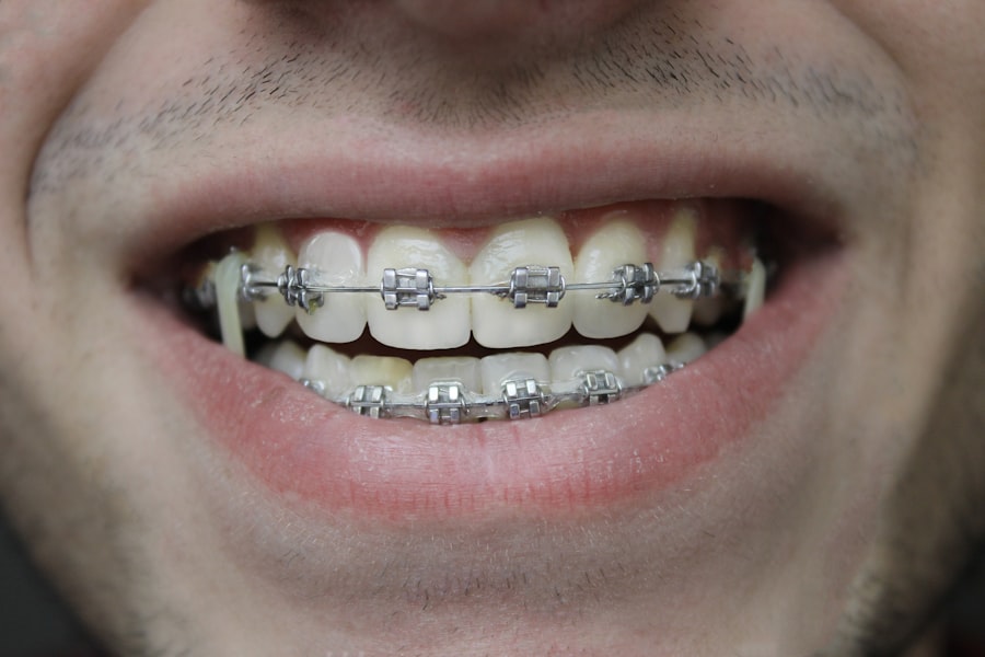 Ortodoncia brackets (mensualidad)